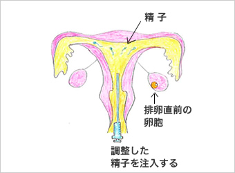 人工授精